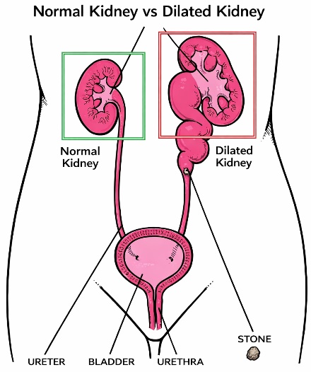 Dilation of a kidney caused by obstruction from a kidney stone in the ureter
